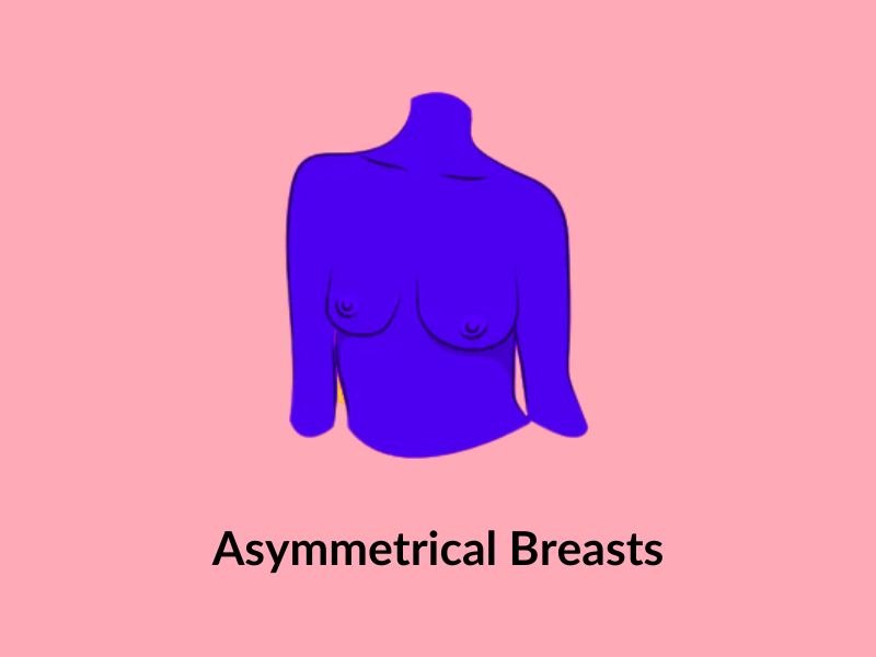 Asymmetrical breasts