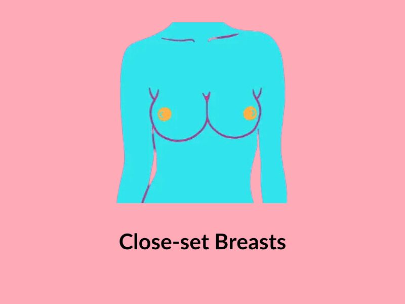 Close set breasts