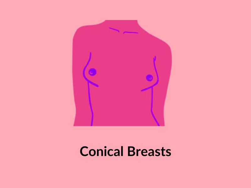 Conical breasts