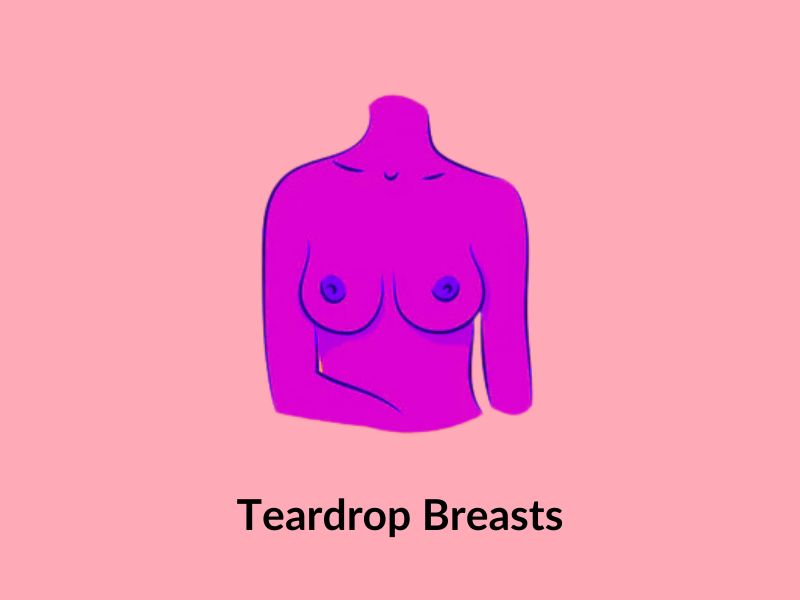 Teardrop breasts