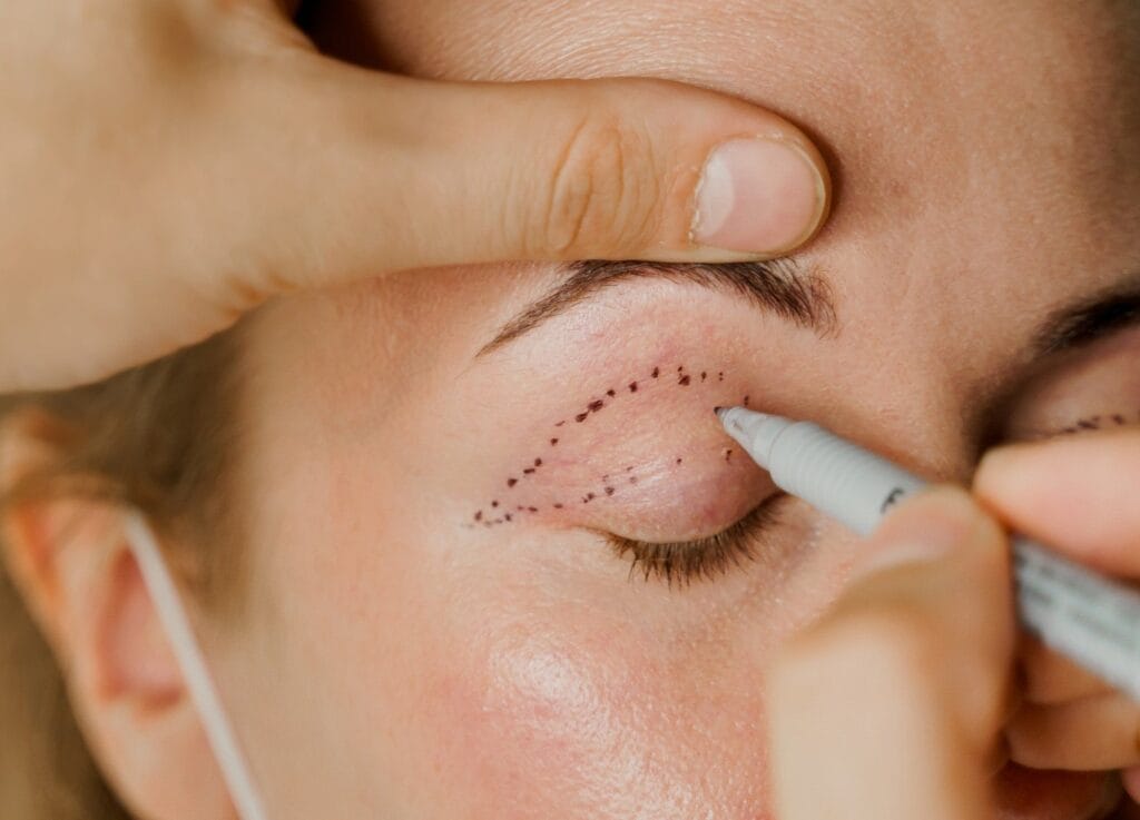 Close-up of a cosmetic procedure where a practitioner's hands use a grey medical marker to draw a dotted outline on a patient's eyelid for a blepharoplasty surgery. The lighting is soft and professional, highlighting natural skin texture without makeup. The subject exhibits feminine facial features with visible eyelashes and brow. The background is softly blurred and neutral, focusing entirely on the anatomical eyelid area; a faint white medical mask strap is visible near the ear, suggesting a sterile clinical environment.