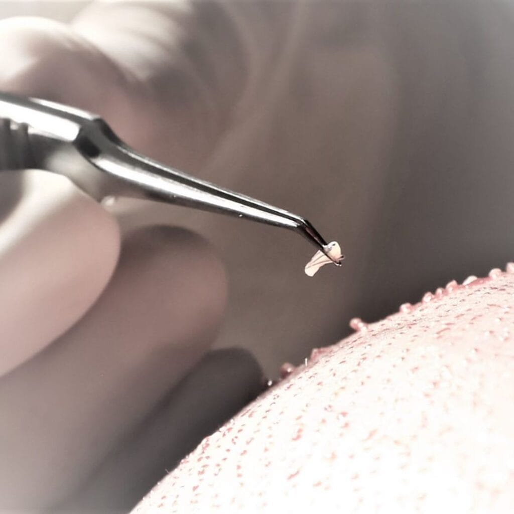 Close-up medical shot of a hair transplant procedure. A professional uses sterile metal tweezers to carefully handle a tiny, single hair follicle graft. The person performing the procedure is wearing medical gloves. The skin area, likely the scalp, shows the texture of the skin with tiny puncture marks from the implantation process. The lighting is soft, clinical, and bright, focusing on the detail of the graft. No makeup or clothing is visible; the focus is entirely on the anatomical procedure of hair restoration in a clinical setting. The background is a soft, out-of-focus medical environment. The image is gender-neutral, focusing purely on the medical technique.