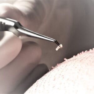 Saç ekimi işleminin yakın çekimi. Steril metal cımbız kullanarak tek bir saç kökü greftini dikkatle tutan bir profesyonel. İşlemi yapan kişi tıbbi eldiven giymektedir. Cilt bölgesi, muhtemelen kafa derisi, implantasyon işleminden kaynaklanan küçük delik izleriyle cildin dokusunu göstermektedir. Işık yumuşak, klinik ve parlaktır ve greftin detayına odaklanır. Makyaj veya kıyafet görünmemekte; odak tamamen klinik bir ortamda saç restorasyonunun anatomik prosedürü üzerindedir. Arka plan yumuşak, odak dışı bir tıbbi ortamdır. Görüntü cinsiyet nötrdür ve tamamen tıbbi tekniğe odaklanır.