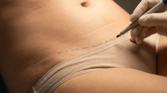 A hyper-realistic, clinical close-up shot captured with an 85mm macro lens, emphasizing surgical precision and anatomical detail. The image focuses on a patient's lower abdomen, where a practitioner wearing a sterile white latex glove uses a medical marker to trace a dotted guideline for a procedure. The lighting is soft and diffused, characteristic of a professional medical environment, creating gentle highlights that accentuate the smooth texture of the skin. The focus is sharp on the intersection of the marker tip and the skin, showcasing micro-details of the epidermis. The patient is wearing beige, cotton-blend underwear, providing a neutral backdrop that directs attention to the surgical planning. The composition is clean and minimalist, maintaining a sophisticated, clinical-aesthetic atmosphere typical of high-end cosmetic surgical documentation.