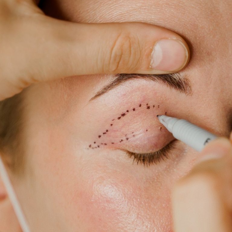 Close-up of a cosmetic procedure where a practitioner's hands use a grey medical marker to draw a dotted outline on a patient's eyelid for a blepharoplasty surgery. The lighting is soft and professional, highlighting natural skin texture without makeup. The subject exhibits feminine facial features with visible eyelashes and brow. The background is softly blurred and neutral, focusing entirely on the anatomical eyelid area; a faint white medical mask strap is visible near the ear, suggesting a sterile clinical environment.