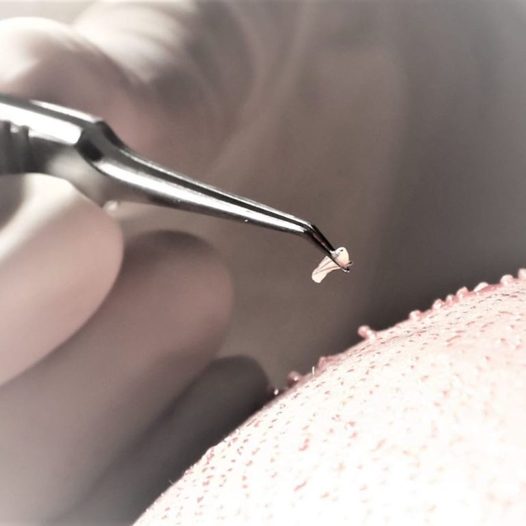 Close-up medical shot of a hair transplant procedure. A professional uses sterile metal tweezers to carefully handle a tiny, single hair follicle graft. The person performing the procedure is wearing medical gloves. The skin area, likely the scalp, shows the texture of the skin with tiny puncture marks from the implantation process. The lighting is soft, clinical, and bright, focusing on the detail of the graft. No makeup or clothing is visible; the focus is entirely on the anatomical procedure of hair restoration in a clinical setting. The background is a soft, out-of-focus medical environment. The image is gender-neutral, focusing purely on the medical technique.