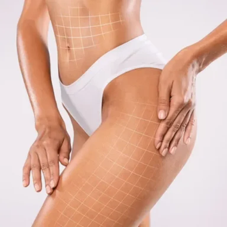 A close-up studio shot of a female figure focusing on the torso and upper leg, with smooth, glowing skin tone, bright and even professional lighting, no makeup relevant to the frame, highlighting a feminine silhouette with white minimalist high-cut underwear, against a neutral, plain background, featuring superimposed white grid lines on the abdomen and thigh area for aesthetic or cosmetic analysis.